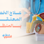 علاج الخصية المعلقة بالمنظار