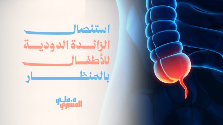 استئصال الزائدة الدودية للأطفال بالمنظار