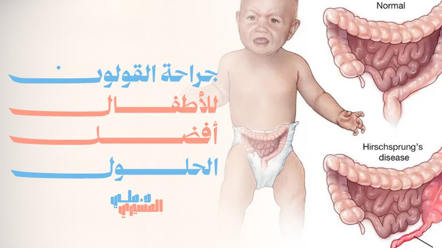 جراحة القولون للأطفال: أفضل الحلول الآمنة والمبتكرة