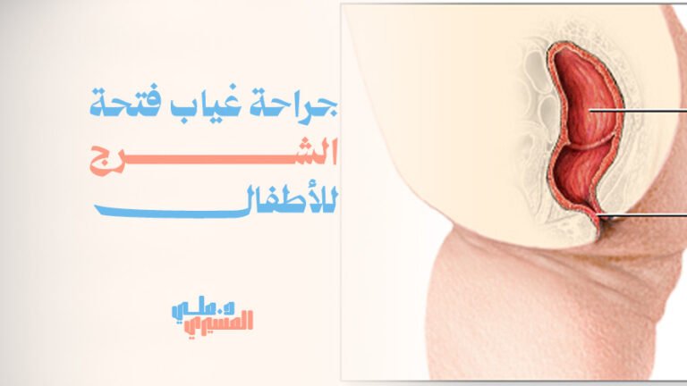 جراحة غياب فتحة الشرج للأطفال