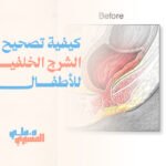 كيفية تصحيح فتحة الشرج الخلفية للأطفال