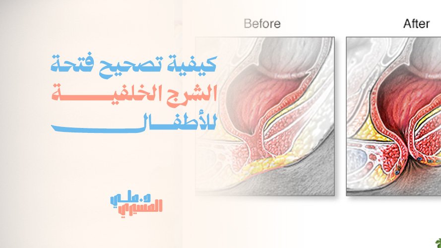 كيفية تصحيح فتحة الشرج الخلفية للأطفال بخبرة طبية عالية