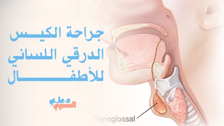 جراحة الكيس الدرقي اللساني للأطفال