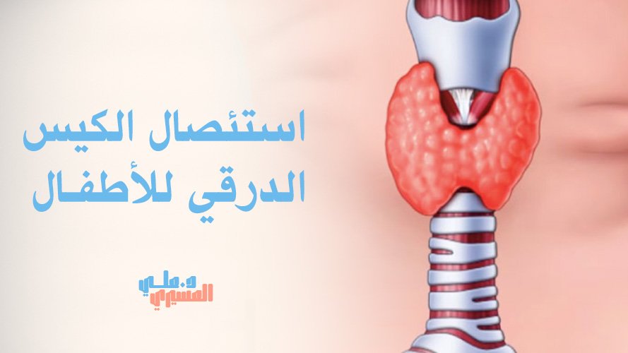 استئصال الكيس الدرقي للأطفال | جراحة متطورة وآمنة