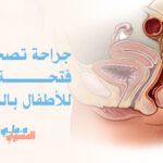 جراحة تصحيح فتحة الشرج للأطفال بالسعودية