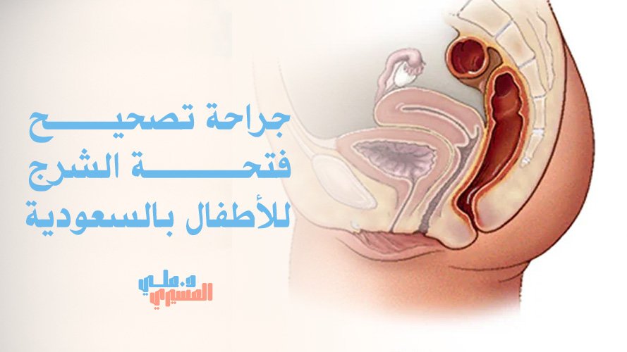 جراحة تصحيح فتحة الشرج للأطفال بالسعودية | جراحة متخصصة
