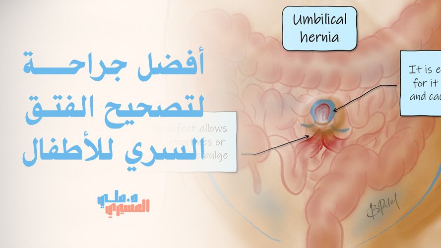 أفضل جراحة لتصحيح الفتق السري للأطفال في السعودية | استشاريون معتمدون