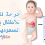 جراحة القولون للأطفال بجنوب السعودية