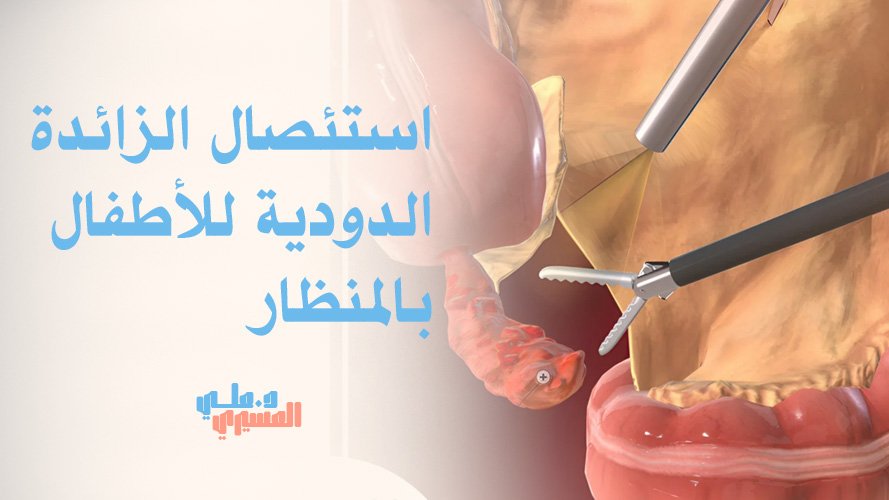 استئصال الزائدة الدودية للأطفال بالمنظار بأمان | احجز الآن