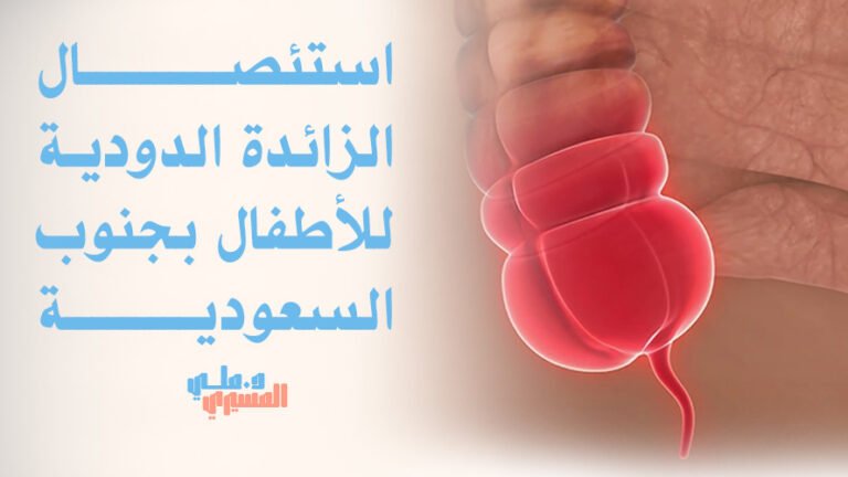 استئصال الزائدة الدودية للأطفال بجنوب السعودية