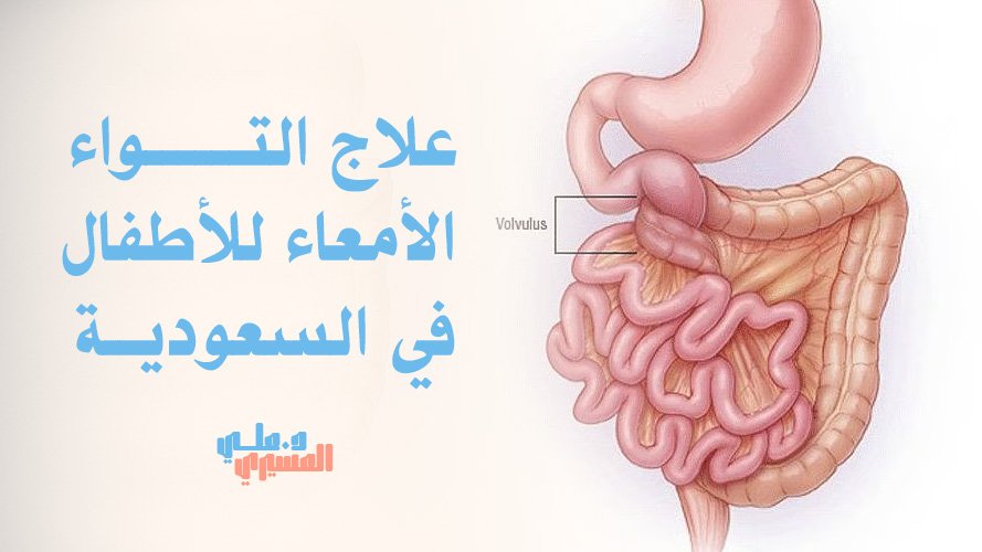 علاج التواء الأمعاء للأطفال في السعودية,تشخيص سريع ورعاية شاملة