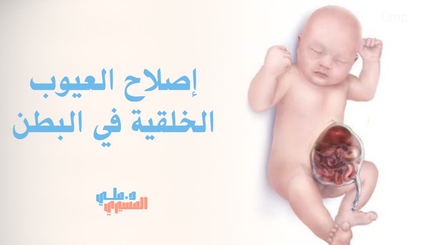 كل ما تود معرفته عن إصلاح العيوب الخلقية في البطن