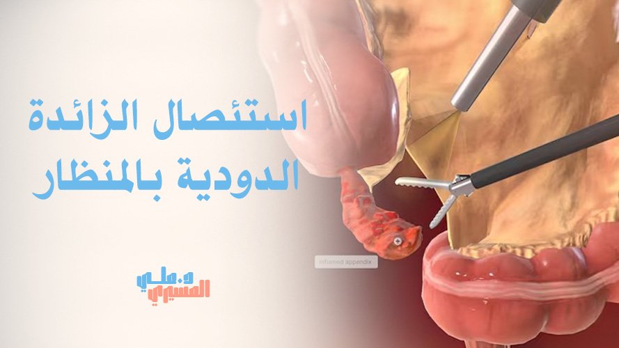 استئصال الزائدة الدودية بالمنظار