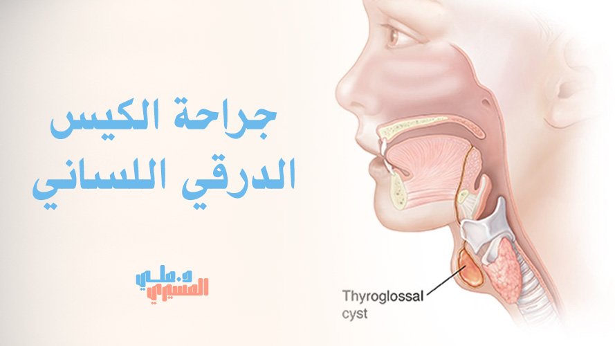 كل ما تود معرفته عن جراحة الكيس الدرقي اللساني