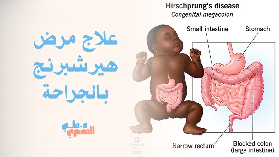 أحدث أساليب علاج مرض هيرشبرنج بالجراحة عبر الشرج