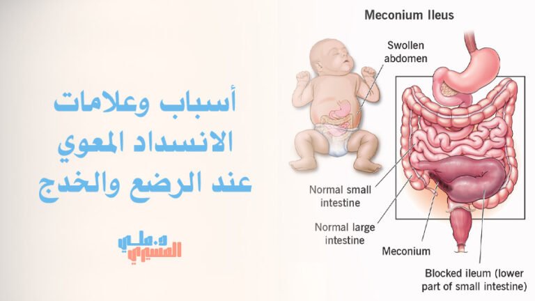 أسباب وعلامات الانسداد المعوي عند الرضع والخدج