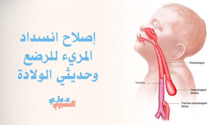 إصلاح انسداد المريء للرضع وحديثي الولادة