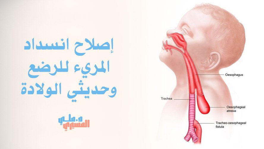 إصلاح انسداد المريء للرضع وحديثي الولادة بأمان