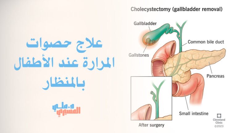 علاج حصوات المرارة عند الأطفال بالمنظار