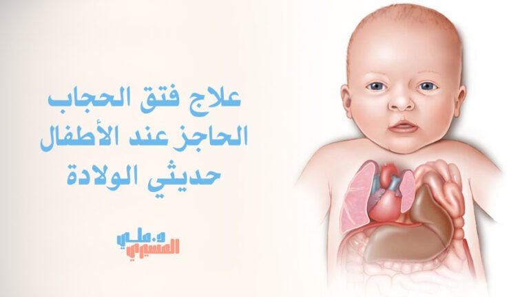 علاج فتق الحجاب الحاجز عند الأطفال حديثي الولادة
