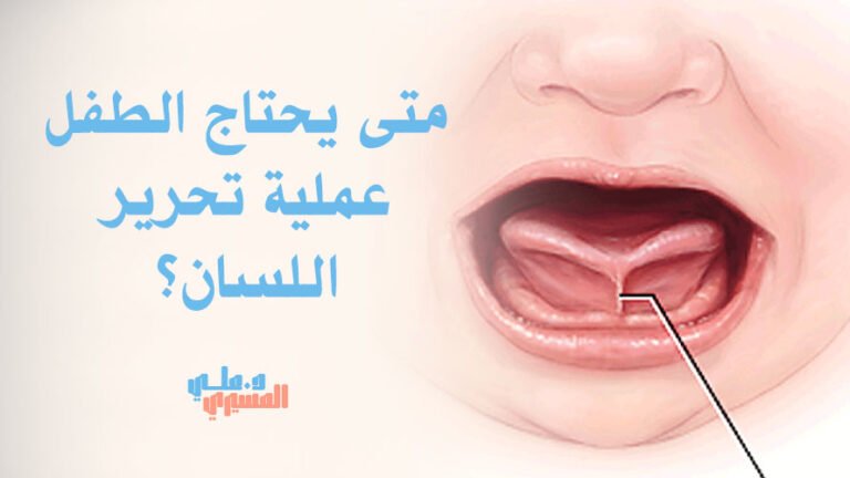 متى يحتاج الطفل عملية تحرير اللسان؟