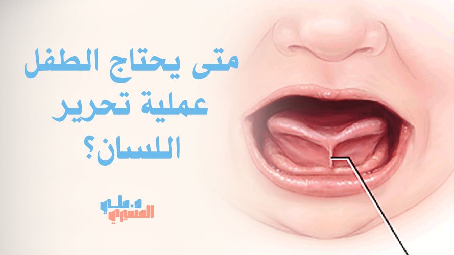 متى يحتاج الطفل عملية تحرير اللسان؟ | الأعراض وأفضل توقيت للعلاج